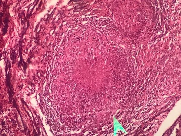 男35岁左膝盖软痛睡觉也痛,左膝关节软组织肿胀