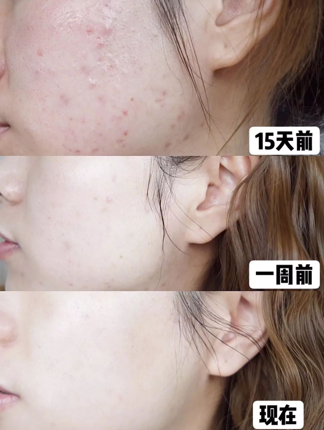 鼻尖挤出白色的是什么,鼻子上挤出的白丝怎么解决