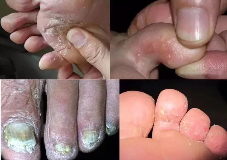 十年脚气怎么治才能除根,十年顽固脚气