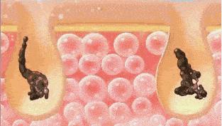 用黑头仪吸完黑头黑头还会再长吗,黑头别膨胀3招把你刷光光