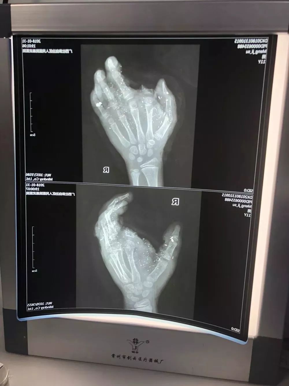 手机充电冒烟发烫,手机一晚上没关发烫到爆炸