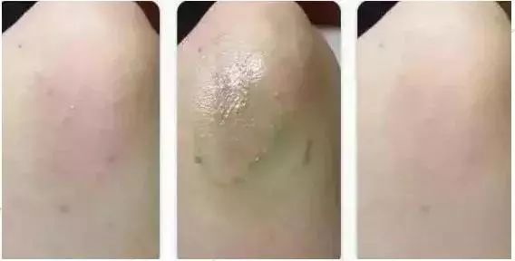 泰国青草膏驱蚊止痒防蚊虫叮咬,泰国蚊子叮咬止痒膏