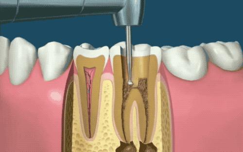 根管治疗没那么可怕,根管治疗有什么意义吗