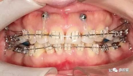 一笑就露出牙花怎么办,口呼吸导致的露龈笑如何治疗
