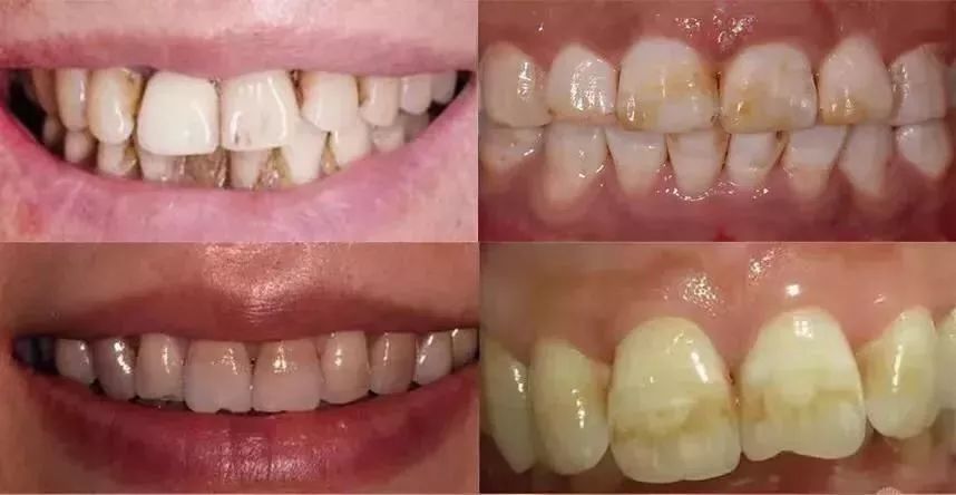 团购|俄罗斯亮白牙膏组合，轻松瓦解多年牙垢，清新口气告别黄牙