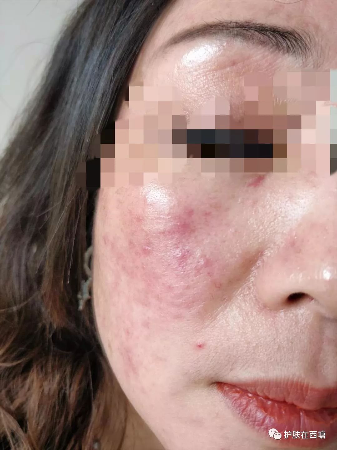 关于皮肤皮炎的几种症状,面部皮炎中医诊断名称