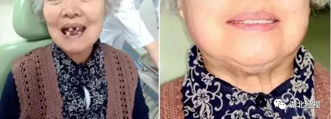 武汉种植牙齿需要多少钱,武汉种植牙齿一颗要多少钱