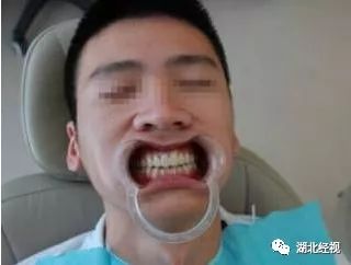 武汉种植牙齿需要多少钱,武汉种植牙齿一颗要多少钱