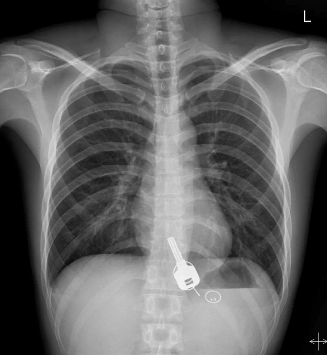 男子酒醒后胸口很痛，去医院检查一看，惊呆了？