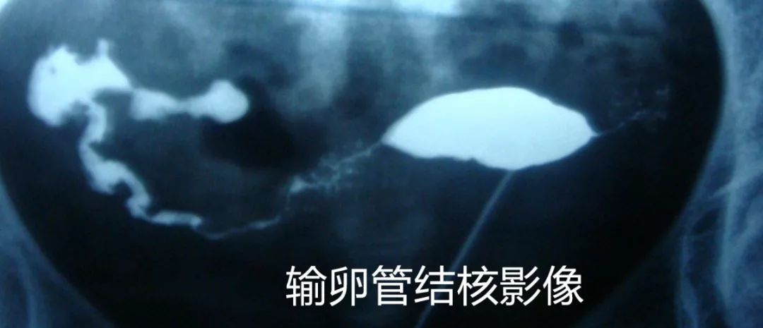 不孕不育科【好孕】病例分享（三）｜中药保留灌肠治疗输卵管性不孕疗效佳