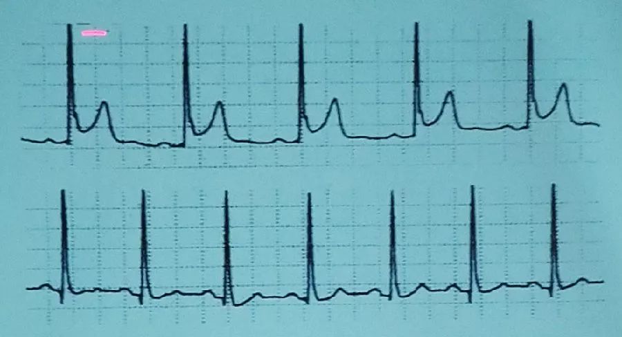 吴永全：如何运用体表心电图预测心脏性猝死风险？｜OCC2019