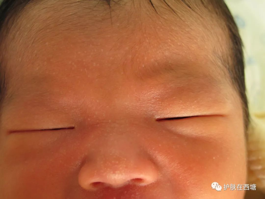 常见面部皮肤病,三脂溢性皮炎