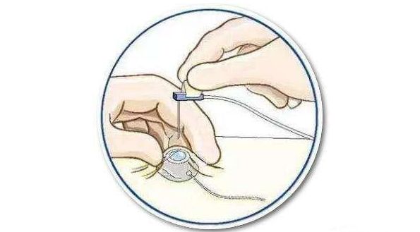 如何给输液港输液,输液港输液还是疼啊