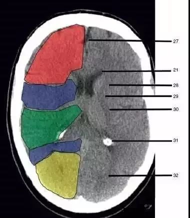 颅脑影像读片教程,颅脑影像读片怎么看