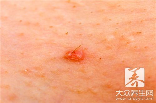 毛襄炎怎么治疗最快