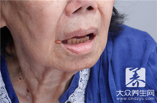 内嘴唇溃疡用什么药,嘴唇咬破溃疡怎么好得快