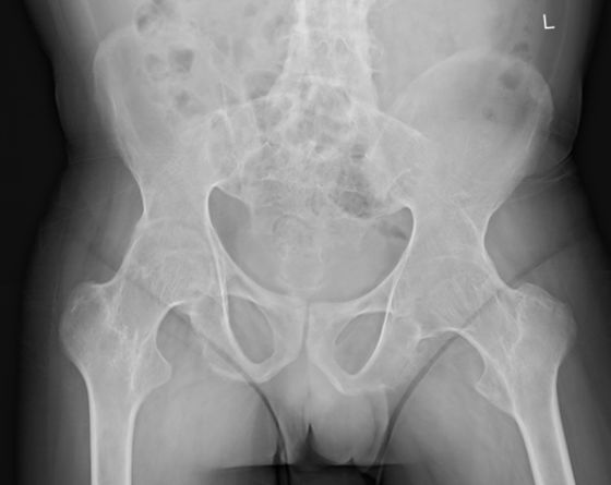 骨道堂治疗强直性脊柱炎效果,御医堂治疗强直性脊柱炎