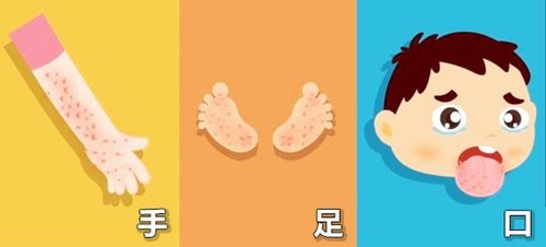 手足口病大人怎么预防,手足口病夏季温馨提示给家长
