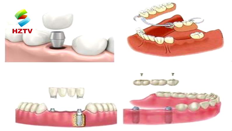 假牙要如何护理不伤害口腔,口腔科健康大讲堂