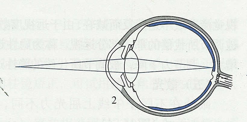 眼科医生检查后，说孩子眼睛“屈光不正”，是什么意思？