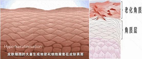 脸上搓下来很多泥,脸上搓出黑头