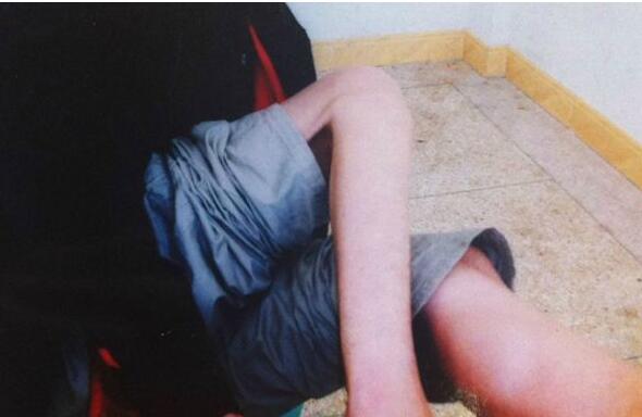 引起肌肉萎缩的原因,如何正确快速的诊断肌肉萎缩疾病