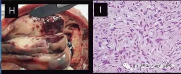 肺动脉分支充盈欠佳是肺栓塞吗,肺动脉缺损不可逆