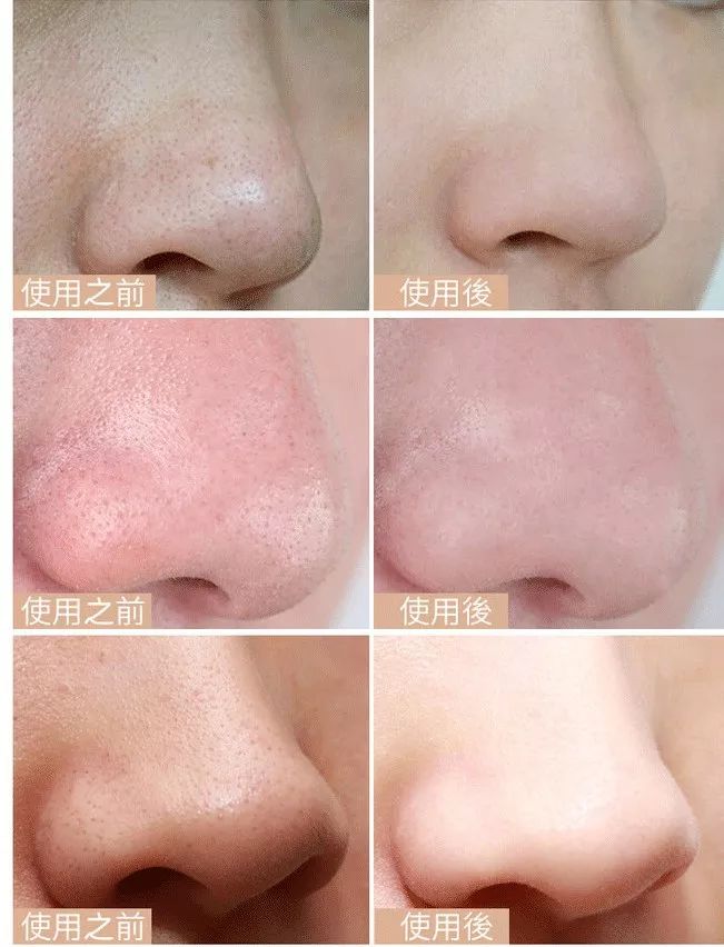 鸡蛋清除黑头,快速物理去黑头