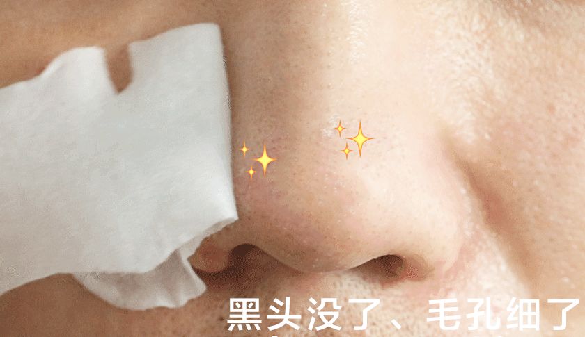 用黑头仪吸完黑头黑头还会再长吗,黑头别膨胀3招把你刷光光