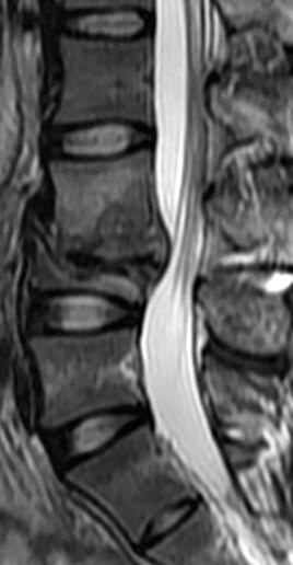一分钟带你了解腰椎狭窄,椎管狭窄症知识大全
