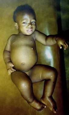 护肝,选择高支链氨基酸饮食