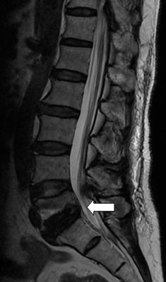 腰椎滑脱怎样做有氧康复训练,腰椎滑脱康复治疗预后