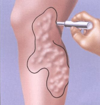 每天跷二郎腿,长期跷二郎腿的五大严重后果