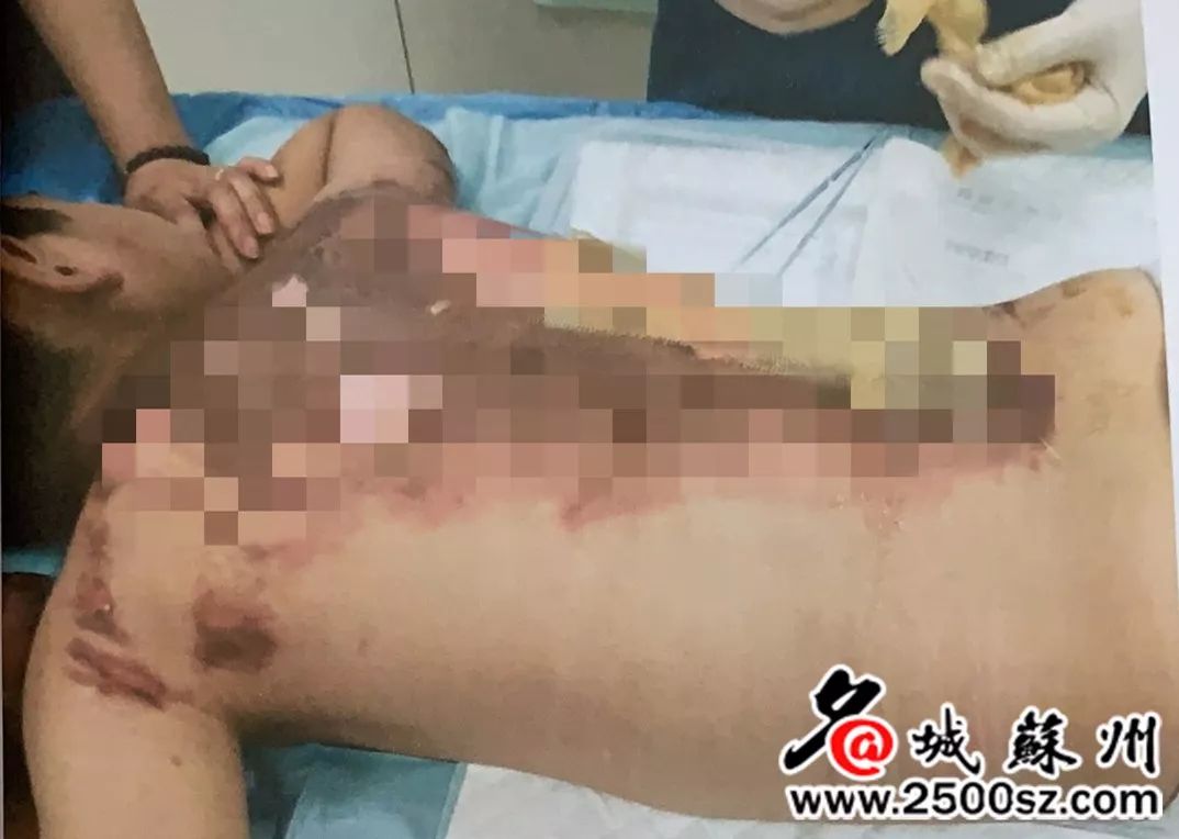 3岁儿子在家无意打翻开水被烫伤,1岁小孩被2000度开水烫伤后续