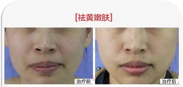 ‘斑’弄是非，超皮秒要你好看