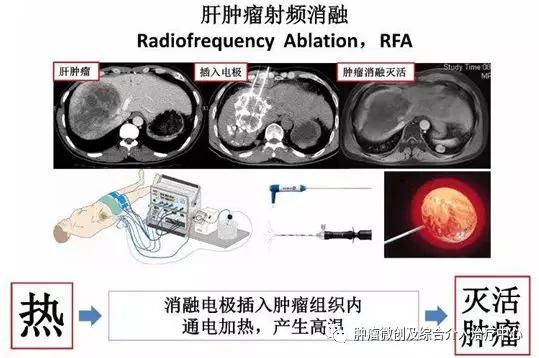 咯血介入治疗后还要止血药吗,肺部大咯血的介入栓塞治疗