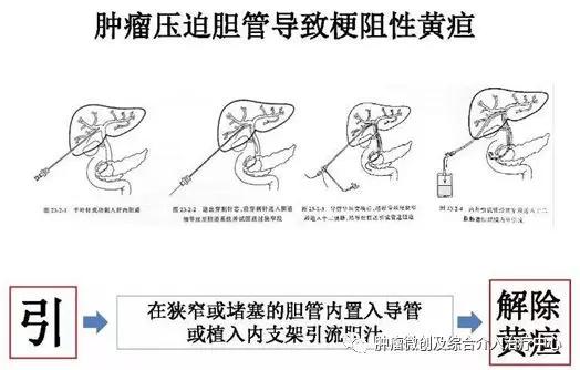 咯血介入治疗后还要止血药吗,肺部大咯血的介入栓塞治疗