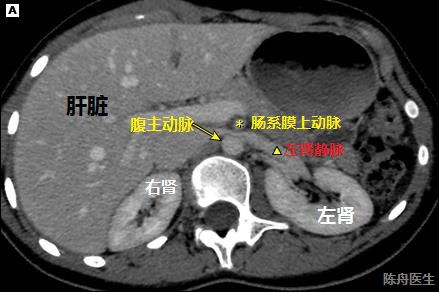 胡桃夹综合征的血尿是肾性血尿吗,胡桃夹血尿是间歇性的吗