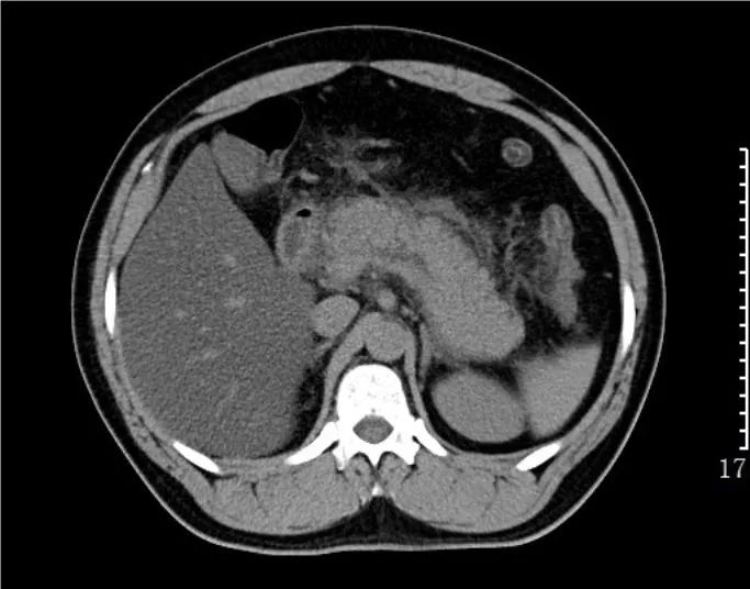 急诊科常见急腹症观察,腹部急诊影像大全值得收藏
