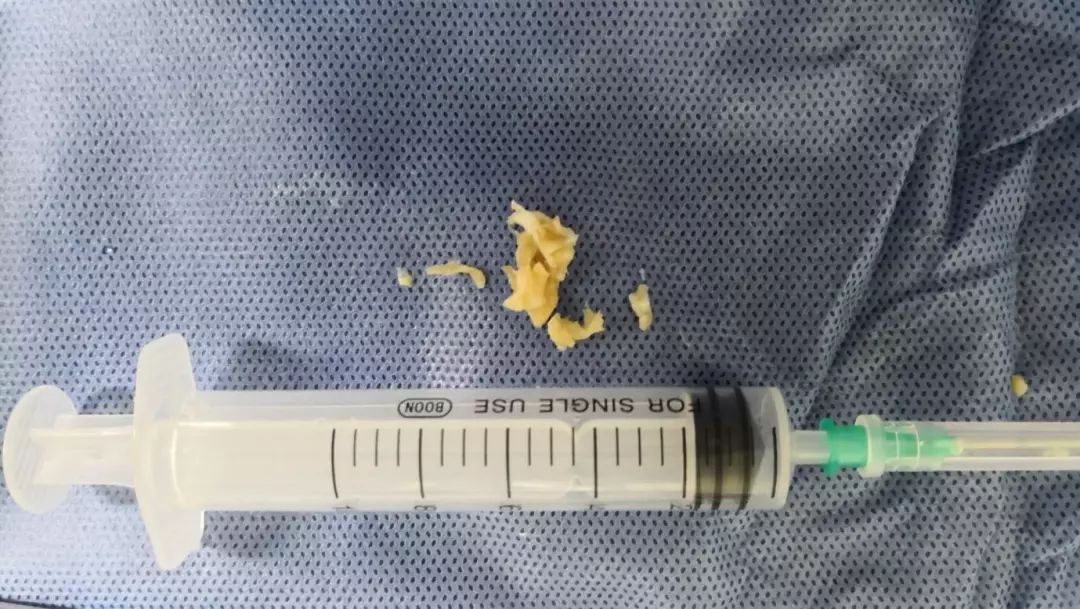 老年人腰椎间盘突出吃什么药止痛,老年人腰椎间盘突出压迫神经腿疼