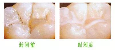 窝沟封闭小学生是免费做吗,下关儿童免费窝沟封闭