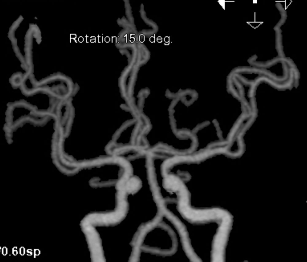 Reco特约·第10期｜国产组合助力取栓“一把通”——Ewata球囊导引导管联合Reco支架取栓分享