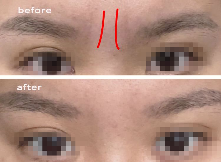 三十岁就有眉间纹法令纹怎么办,30岁法令纹眉心纹深