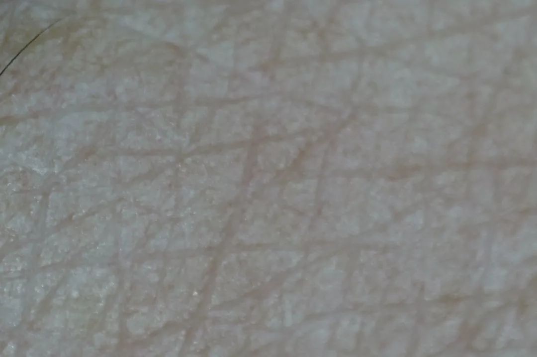 法令纹又黑又长,法令纹又深又长好吗