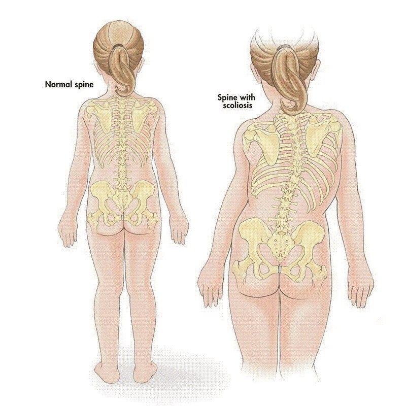 背背佳矫正驼背书包,驼背书包怎么挑选