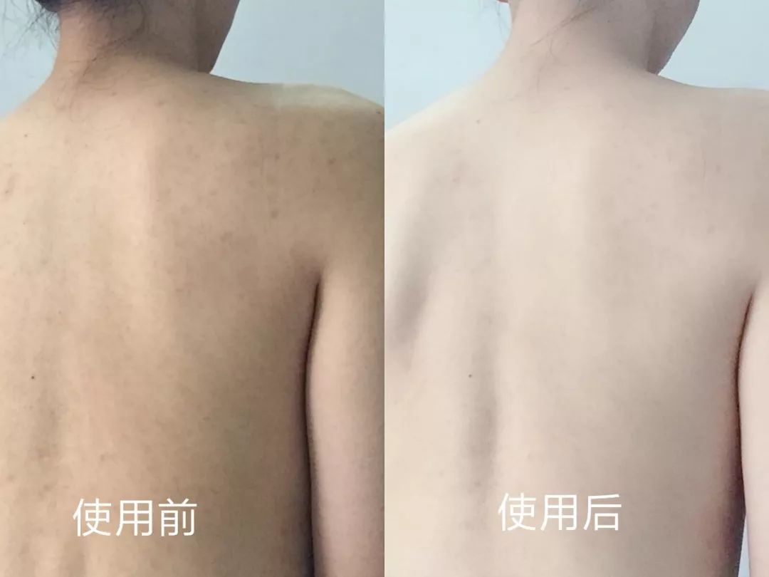 可美金箔祛痘螨虫皂,除螨皂能祛螨虫吗