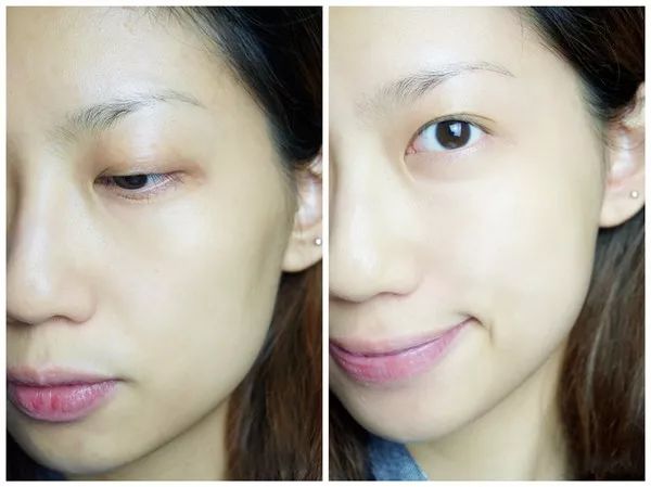 痘痘闭口里面有油脂,鼻子上的痘痘是青春痘还是粉刺