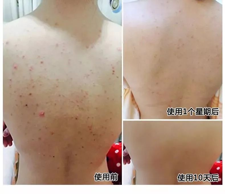 痘痘闭口里面有油脂,鼻子上的痘痘是青春痘还是粉刺