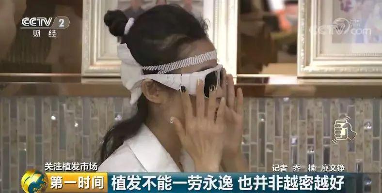 头顶脱发植发有用吗,中国脱发人数2024