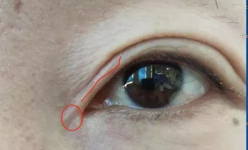 女子整形割双眼皮,女子整容后惨不忍睹